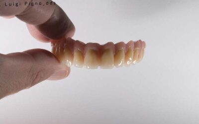 Impianti dentali a carico immediato