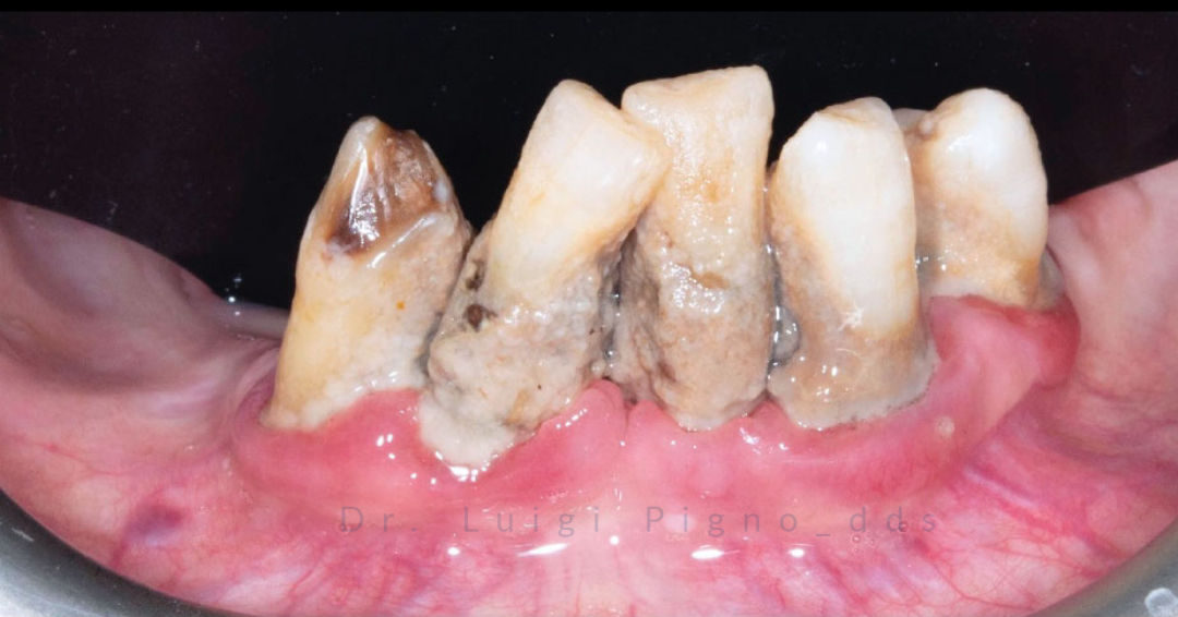 Piorrea: costi e terapie per prevenire la perdita dei denti